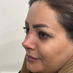 جراحی زیبایی بینی دکتر رامین عیلجانی+نمونه